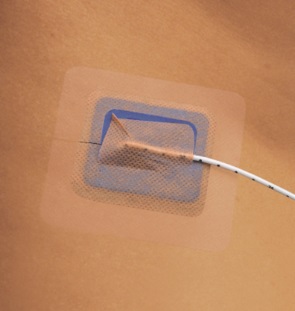 The StayFIX? from Merit Medical Systems, Inc